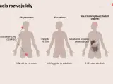 Ilustracja przedstawia stadia rozwoju kiły: pierwotna (wrzód), wtórna (wysypka skórna) i trzeciorzędowa (uszkodzenia narządów).