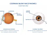 Schemat oka z zaznaczonym czerniakiem błony naczyniowej. Pokazuje czerniaka naczyniówki pod siatkówką i czerniaka tęczówki.