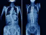 Rentgen klatki piersiowej przed i po operacji skoliozy. Widoczny kręgosłup z implantami stabilizującymi.
