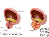 Confronto tra prostata normale e prostata infiammata, dove l'ipertrofia prostatica benigna comprime l'uretra, ostacolando il flusso urinario.