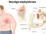 Ilustracja przedstawia mężczyznę z bólem w klatce piersiowej, wskazującym na neuralgię międzyżebrową. Widok anatomiczny ukazuje unerwienie żeber.