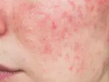 Primo piano del viso con evidenti rossori e imperfezioni cutanee, che suggeriscono una condizione come la rosacea o l'acne.