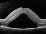 OCT di occhio con corioretinopatia sierosa centrale. Evitare stress e cortisone per non peggiorare la condizione.