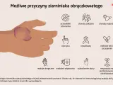 Dłoń z widocznym ziarniniakiem obrączkowatym. Obok ikony symbolizujące możliwe przyczyny: choroby, cukrzyca, nowotwory, leki, alergie, uszkodzenia skóry, promieniowanie UV.
