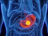 Anatomische Darstellung des menschlichen Oberkörpers mit hervorgehobenem Magen. Ein leuchtend gelber Tumor im Magen könnte ein Anzeichen für Magenkrebs sein.