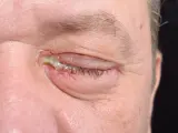 Zapalenie powieki z widoczną białą wydzieliną z oka, zaczerwienieniem i obrzękiem.