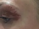 Widoczna opuchlizna po operacji powiek z widocznymi śladami zabiegu. Skóra wokół oka jest zaczerwieniona i lekko podrażniona.