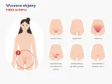 Wczesne objawy raka sromu: świąd, pieczenie, dyskomfort, zgrubienia, grudki, owrzodzenia. Zwróć uwagę na zmiany.