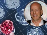 Bruce Willis choroba: obraz rezonansu magnetycznego mózgu obok uśmiechniętej twarzy aktora.