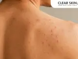 Close-up of shoulder acne. Learn how to get rid of shoulder acne overnight for clearer skin.