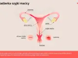 Ilustracja przedstawia budowę narządów rodnych kobiety z zaznaczoną nadżerką szyjki macicy. Obok zdrowej szyjki macicy widoczna jest nadżerka.