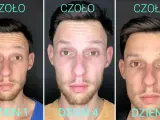 Trzy zdjęcia mężczyzny pokazujące efekt botoksu na czoło: dzień 1 (zmarszczki), dzień 4 (zmniejszone zmarszczki), dzień 7 (gładkie czoło).