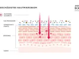 Illustration zeigt ein geschädigtes Hautmikrobiom mit Bakterien und Schmutz, die in die Epidermis eindringen.