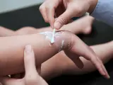 Delikatne smarowanie oparzonej skóry kremem na oparzenia za pomocą patyczka kosmetycznego.