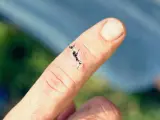 Palec z raną do szycia, czarne nici chirurgiczne zszywają skórę.