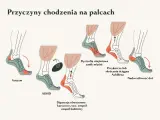 Ilustracja pokazuje, dlaczego dziecko chodzi na palcach: autyzm, ADHD, dystrofia mięśniowa, przykurcz ścięgna Achillesa, dipareza kurczowa i nadwrażliwość dotykowa.