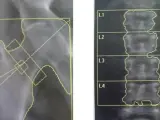Badanie na osteoporozę: RTG biodra i kręgosłupa lędźwiowego z zaznaczonymi obszarami do analizy.
