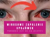 Czerwone, podrażnione oczy z widocznymi naczynkami. Wirusowe zapalenie spojówek objawy są widoczne.