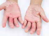 Mani con evidente desquamazione della pelle, arrossamento e secchezza. La pelle appare irritata e screpolata.