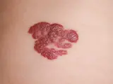 Ein roter, unregelmäßiger Hautfleck, der als mögliches Hautkrebs-Symptom betrachtet werden könnte.