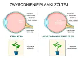 Porównanie normalnego oka z suchym zwyrodnieniem plamki żółtej. Obrazek pokazuje, jak obrzęk plamki żółtej wpływa na widzenie.
