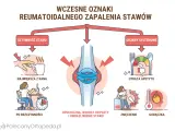 Wczesne objawy zapalenia stawów: sztywność, ból po bezczynności, opuchlizna, utrata apetytu, zmęczenie, gorączka.