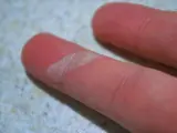Nahaufnahme eines Fingers mit einer offenen Blase, die behandelt werden muss. Die Haut ist gerötet und die Blase ist aufgeplatzt.