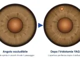 Iridotomia YAG: prima occlusione dell'angolo, dopo apertura per riaprire il deflusso. Valutare i rischi.