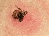 Makro zbliżenie na kleszcza przyczepionego do ludzkiej skóry. Widać jego nogi i odwłok.