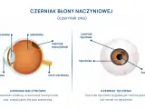 Schemat oka z zaznaczonym czerniakiem naczyniówki i czerniakiem tęczówki. Czerniak oka to poważna choroba.