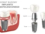 Schemat budowy implantu stomatologicznego: korona, łącznik i śruba.