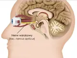 Przekrój głowy ukazujący oko i nerw wzrokowy. Obrzęk tarczy nerwu wzrokowego objawy mogą być widoczne w tej okolicy.