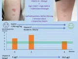 Vitamin D Mangel Symptome bei Erwachsenen: Erfahrungsberichte und Anzeichen