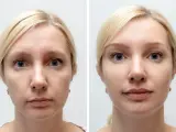 Przed i po zabiegu PRP: skóra twarzy kobiety wygładzona, zmarszczki zredukowane, cera promienna.