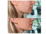 Endermologia twarzy: Lifting bez skalpela? Sprawdź efekty!