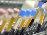 Rękawiczka pobiera probówkę z ciemną krwią i żółtym osoczem. To cea co to za badanie?