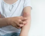 Dziecko drapie swędzącą rękę z zaczerwienioną skórą, objawem co to jest atopowe zapalenie skóry.