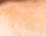 Skóra z zaczerwienieniem i przebarwieniami, objawy fotodermatozy – uczulenia na słońce. Widoczne włoski i pieprzyk.