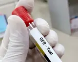 Rękawiczka trzyma probówkę z oznaczeniem "GFR - Test". To jedno z badań na nerki, które ocenia ich pracę.