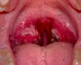 Gola infiammata con placche biancastre, indicative di faringite da streptococco. Le tonsille sono rosse e gonfie.