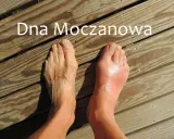 Dwa stopy na drewnianym tle, jeden zdrowy, drugi opuchnięty i zaczerwieniony.