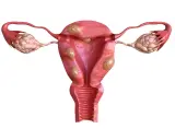 Anatomical illustration of a uterus with multiple fibroids and ovaries.
