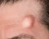 Gros plan sur un front humain, montrant un bouton sous cutané proéminent, légèrement rouge, près de la ligne des cheveux.