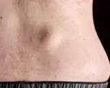 Gros plan sur le dos d'une personne, montrant une peau claire parsemée de petites bosses et d'une excroissance peau plus visible.