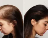 Comparaison avant/après : une femme souffrant d'alopécie frontale fibrosante voit sa chevelure se densifier.
