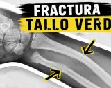 Radiografía de una fractura en tallo verde en el antebrazo, indicada por flechas amarillas.