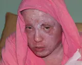 Osoba w różowej bluzie z kapturem, z zaczerwienioną, łuszczącą się skórą twarzy, która może być leczona kremem Bedicort G.