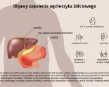 Ilustracja przedstawia anatomię jamy brzusznej z zaznaczonym pęcherzykiem żółciowym, wątrobą i żołądkiem. Wymienia objawy zapalenia pęcherzyka żółciowego: ból, wzdęcia, wymioty, problemy z trawieniem.