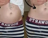 Porównanie brzucha: po lewej widoczne wzdęcia, po prawej płaski. Endometrioza jak wygląda? Czasem tak.