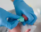 Mani con guanti blu eseguono il test di Guthrie su un neonato, raccogliendo una goccia di sangue dal tallone.